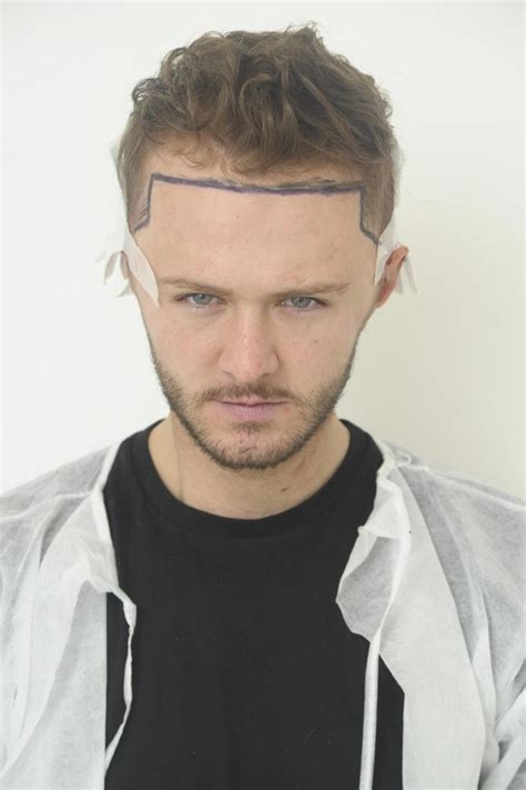 kyle geordie shore hair transplant